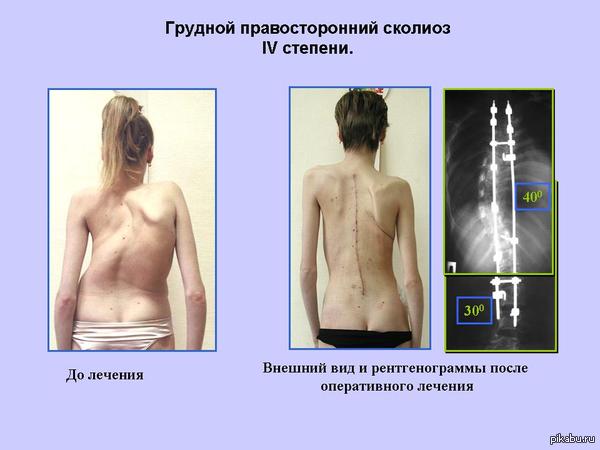 1 степень сколиоза возьмут ли в армию